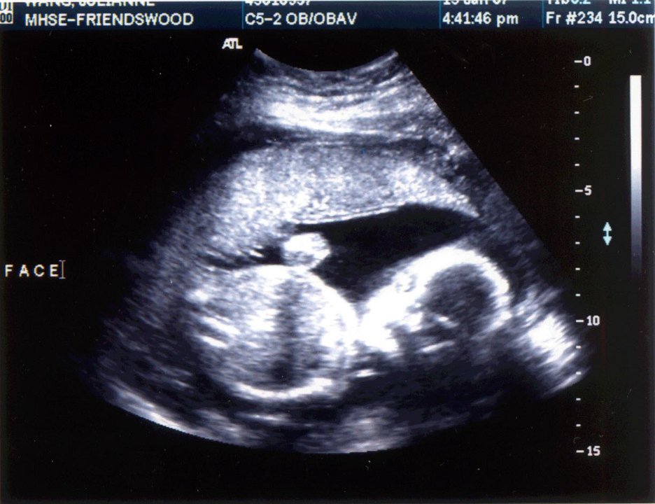 Ultrasound01-15-07