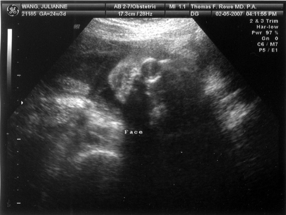 Ultrasound02-05-07-Face