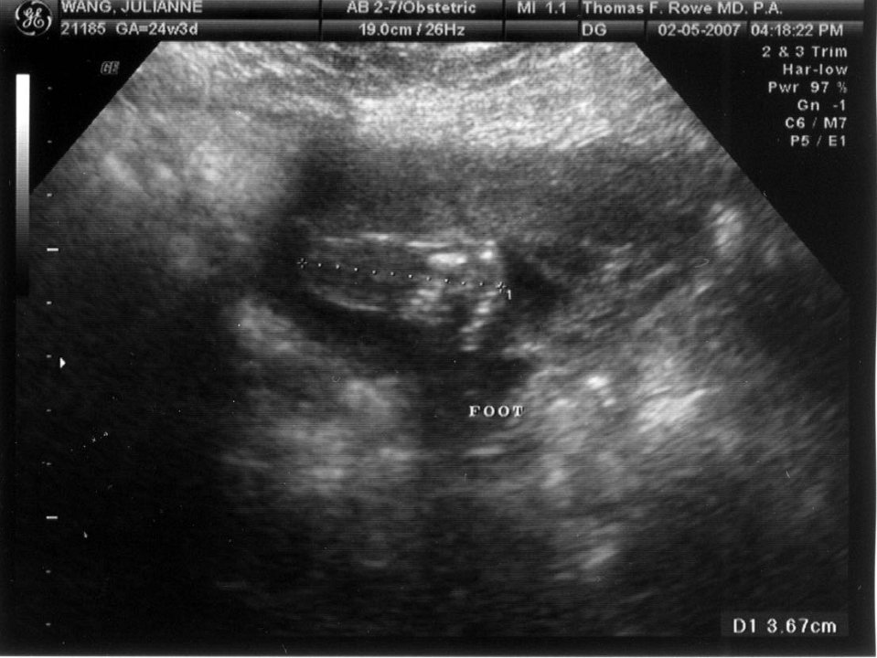 Ultrasound02-05-07-Foot