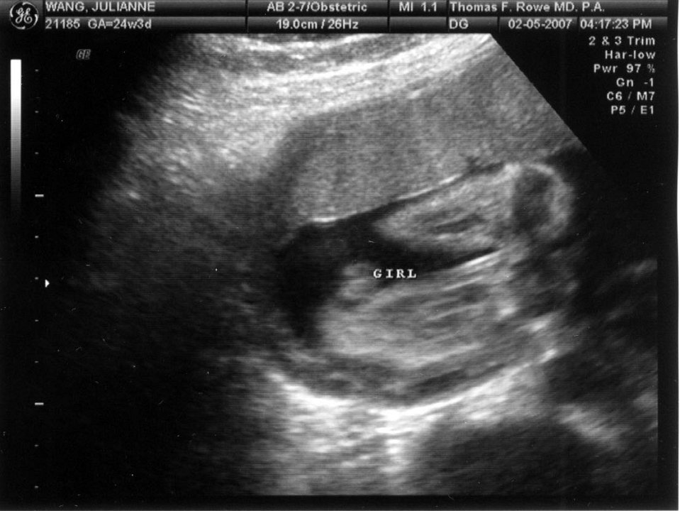 Ultrasound02-05-07-Girl